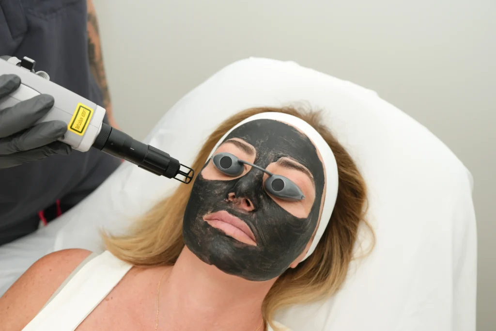 Carbon Hollywood Facial