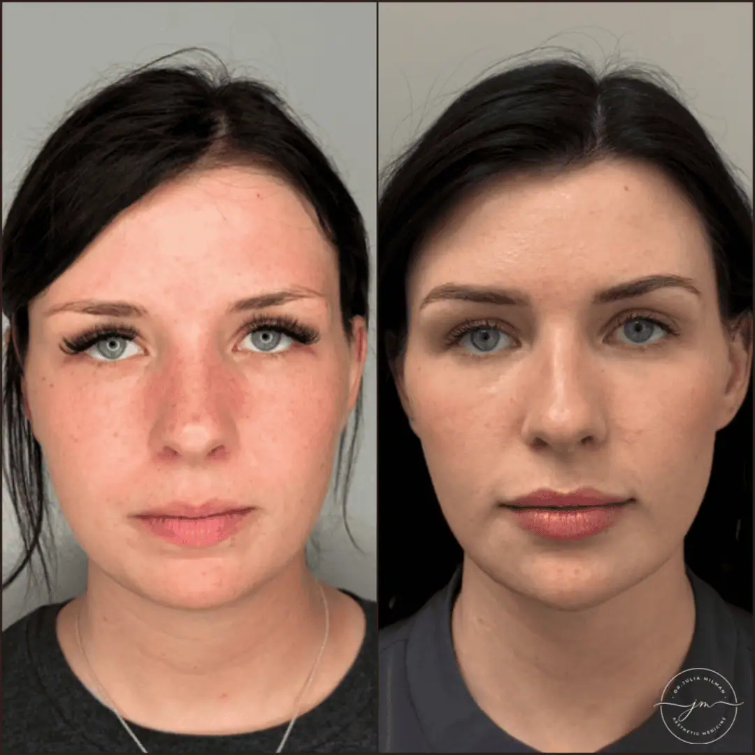 Dermal Fillers Before-Afters (10)
