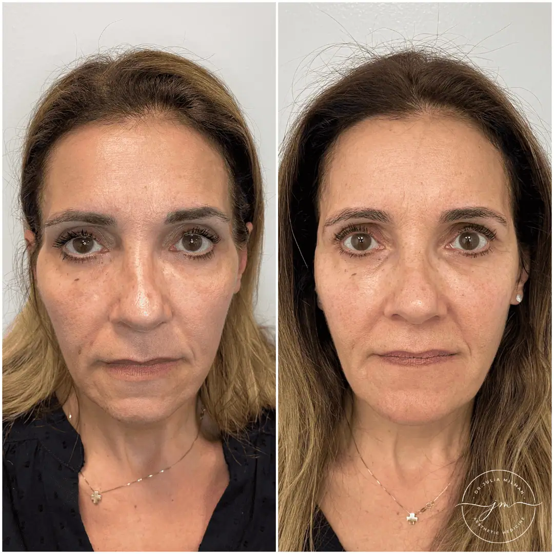 Dermal Fillers Before-Afters (2)