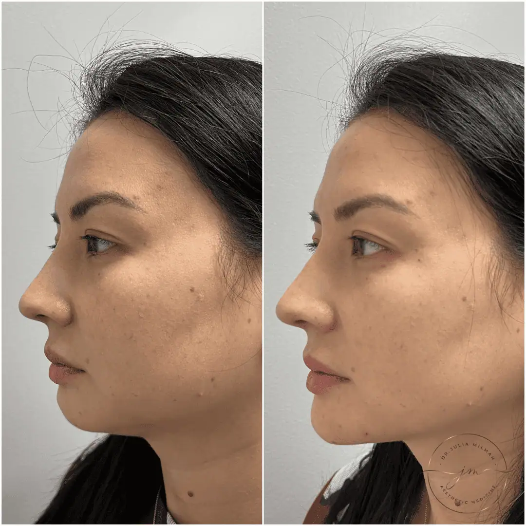 Dermal Fillers Before-Afters (3)