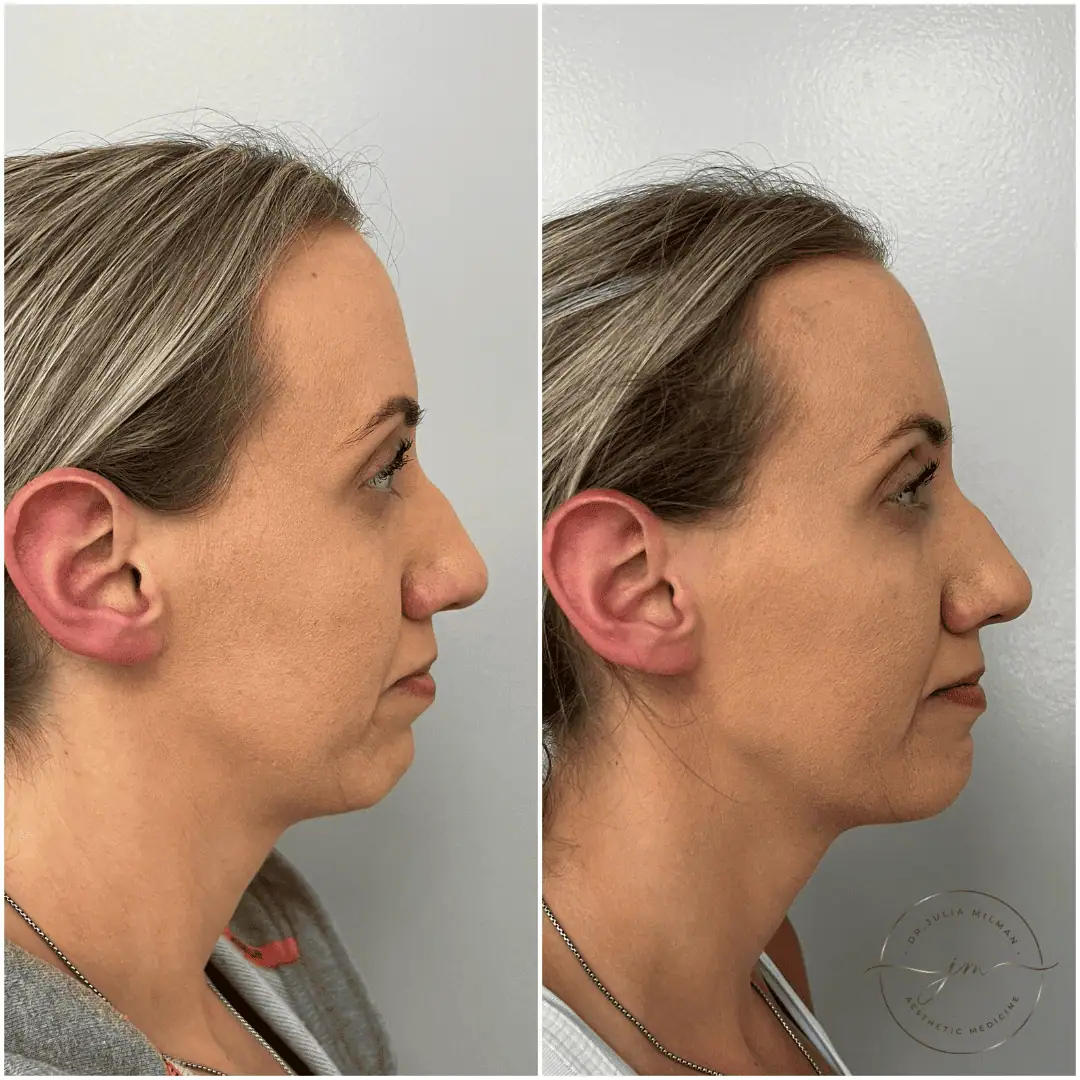Dermal Fillers Before-Afters (4)