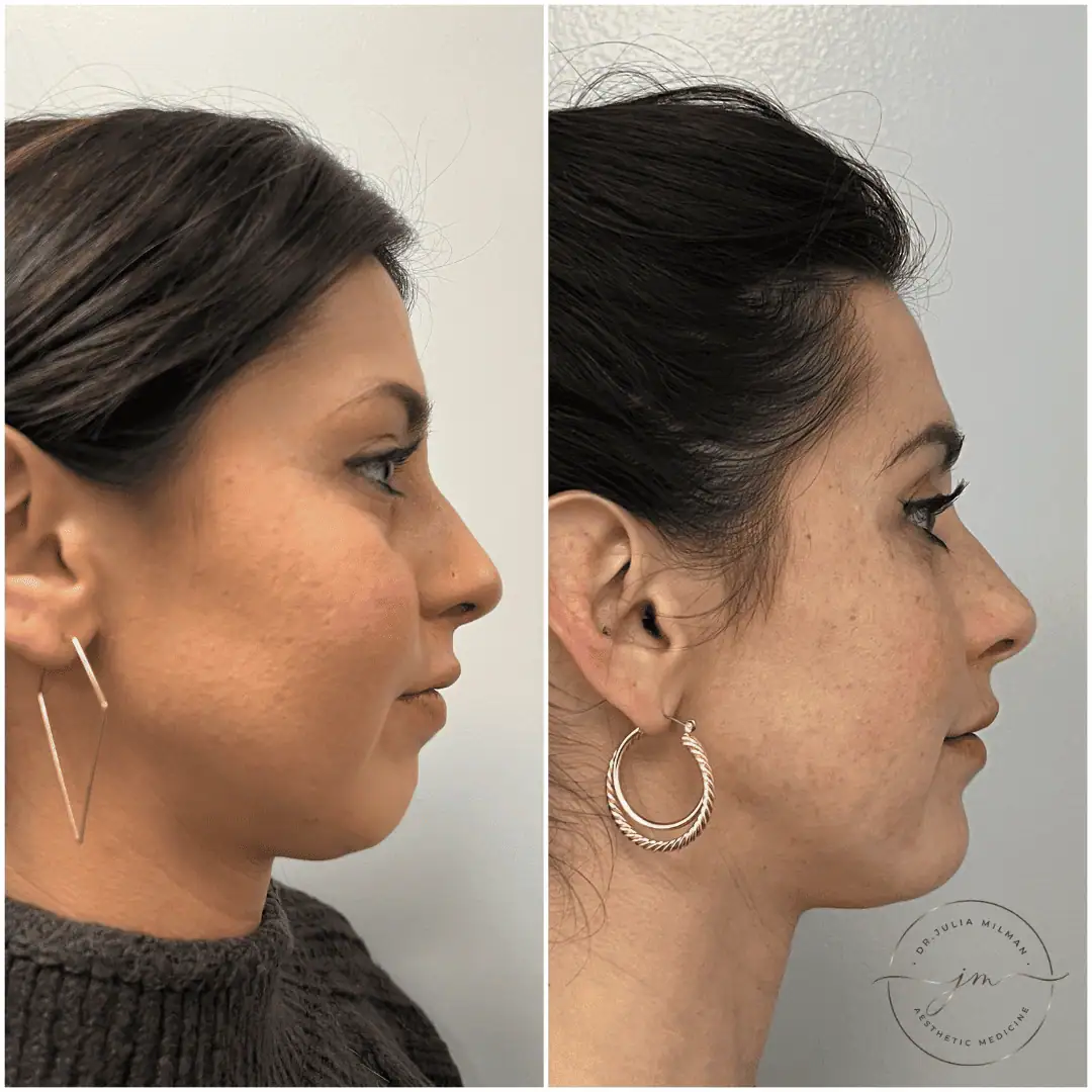 Dermal Fillers Before-Afters (5)