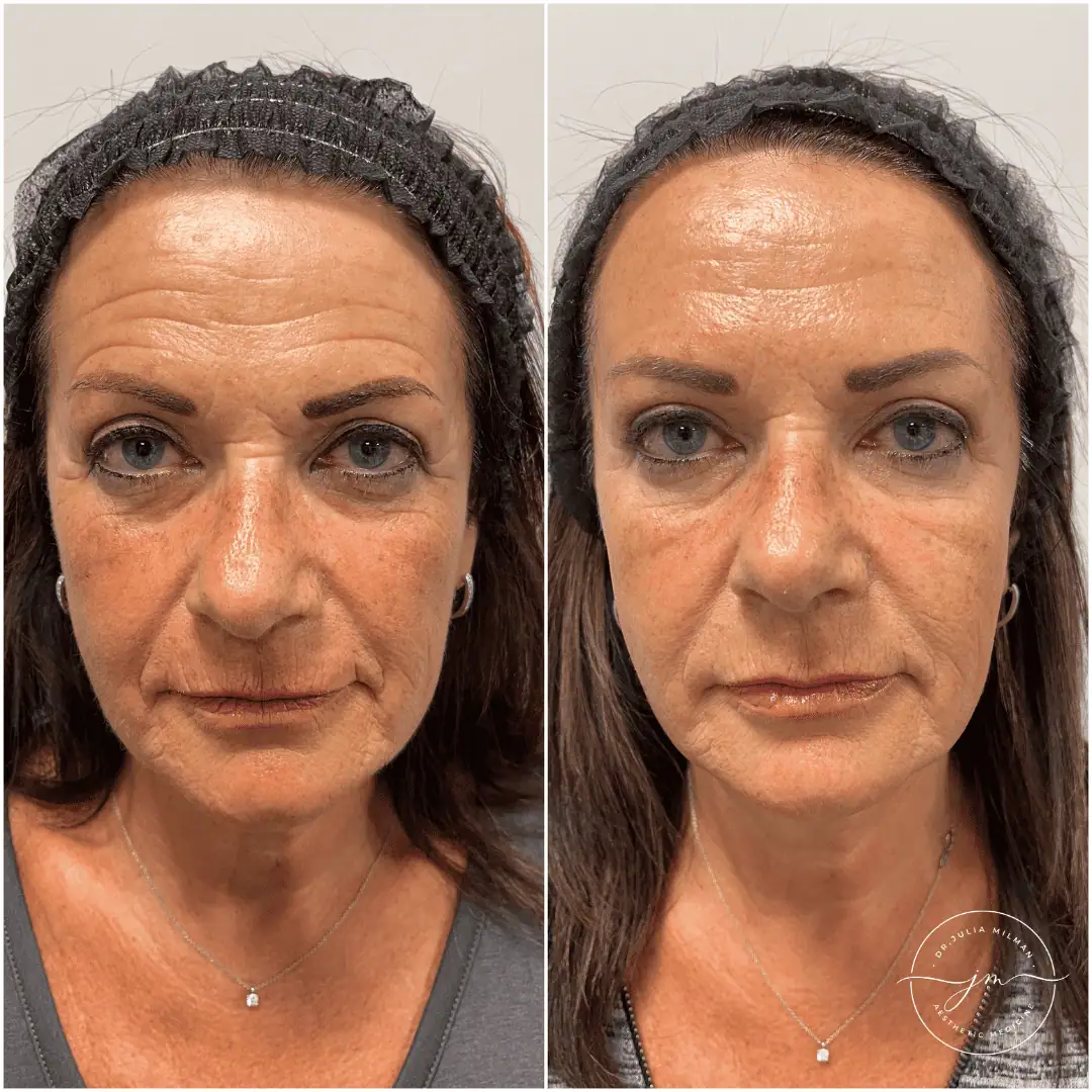 Dermal Fillers Before-Afters (7)