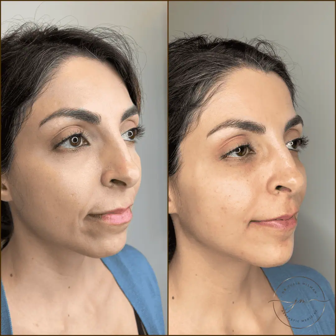 Dermal Fillers Before-Afters (8)