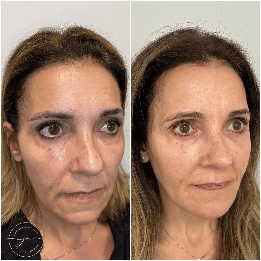 Dermal Fillers Before-Afters (9)