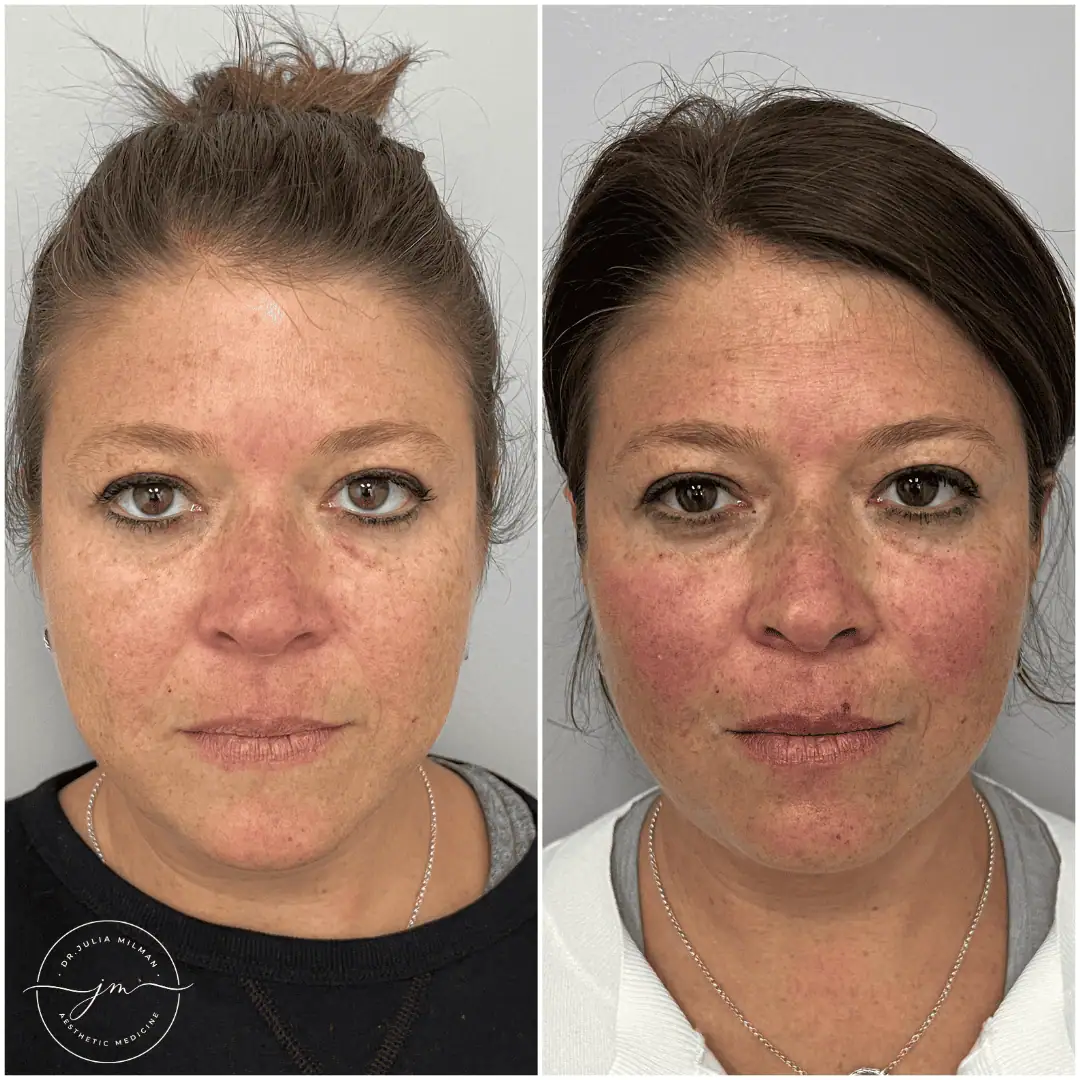 Dermal Fillers Before-Afters
