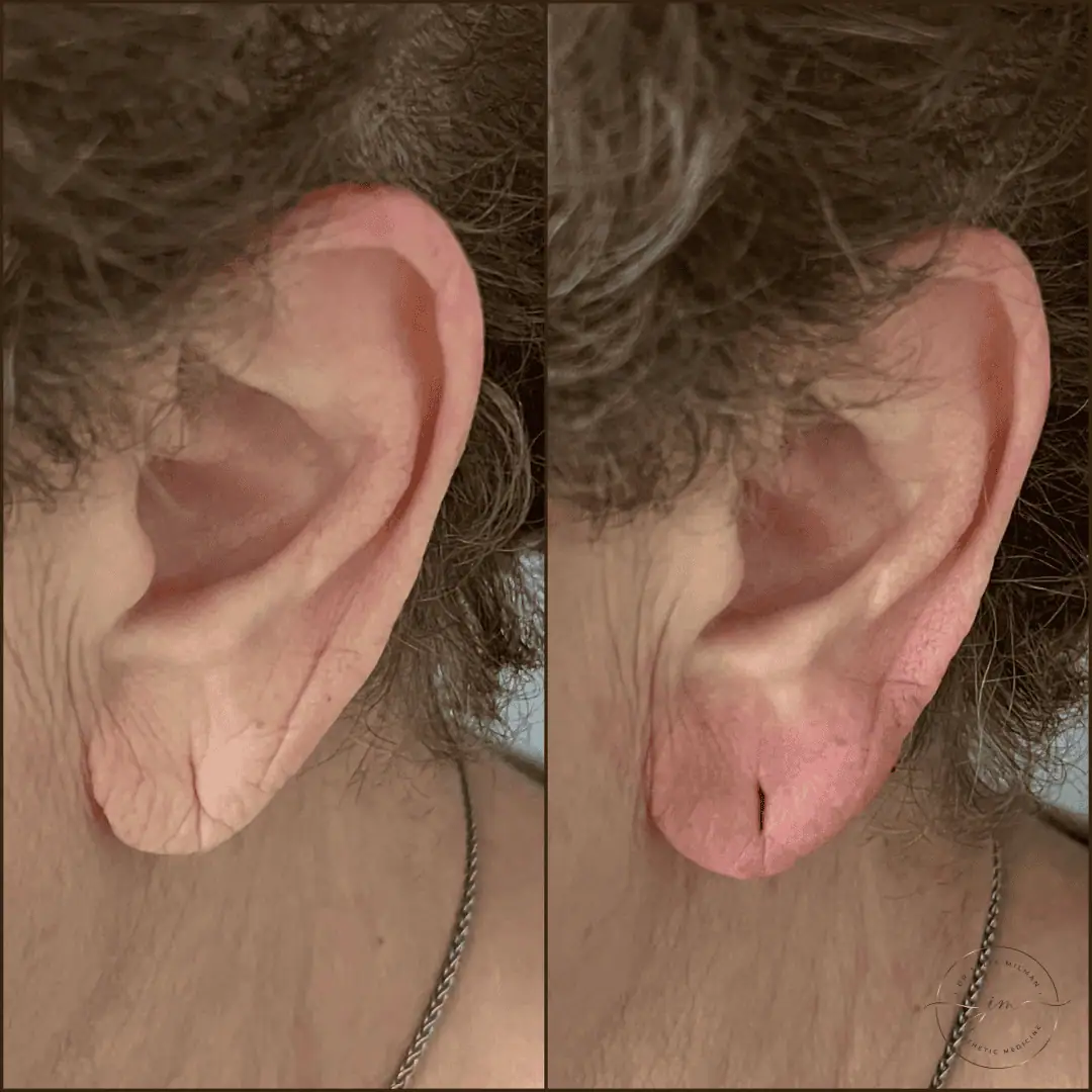 earlobe rejuvenation (1)
