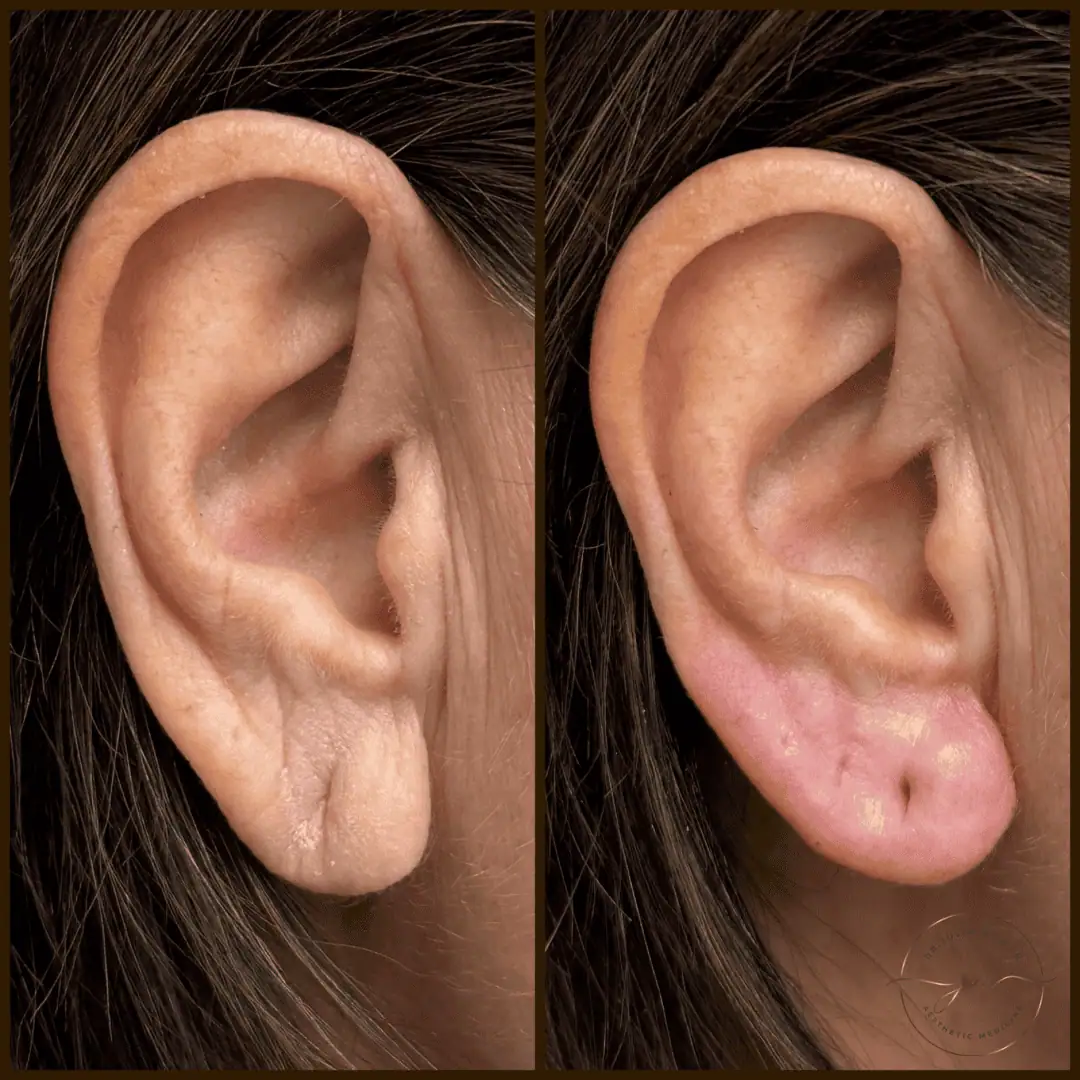 earlobe rejuvenation (10)