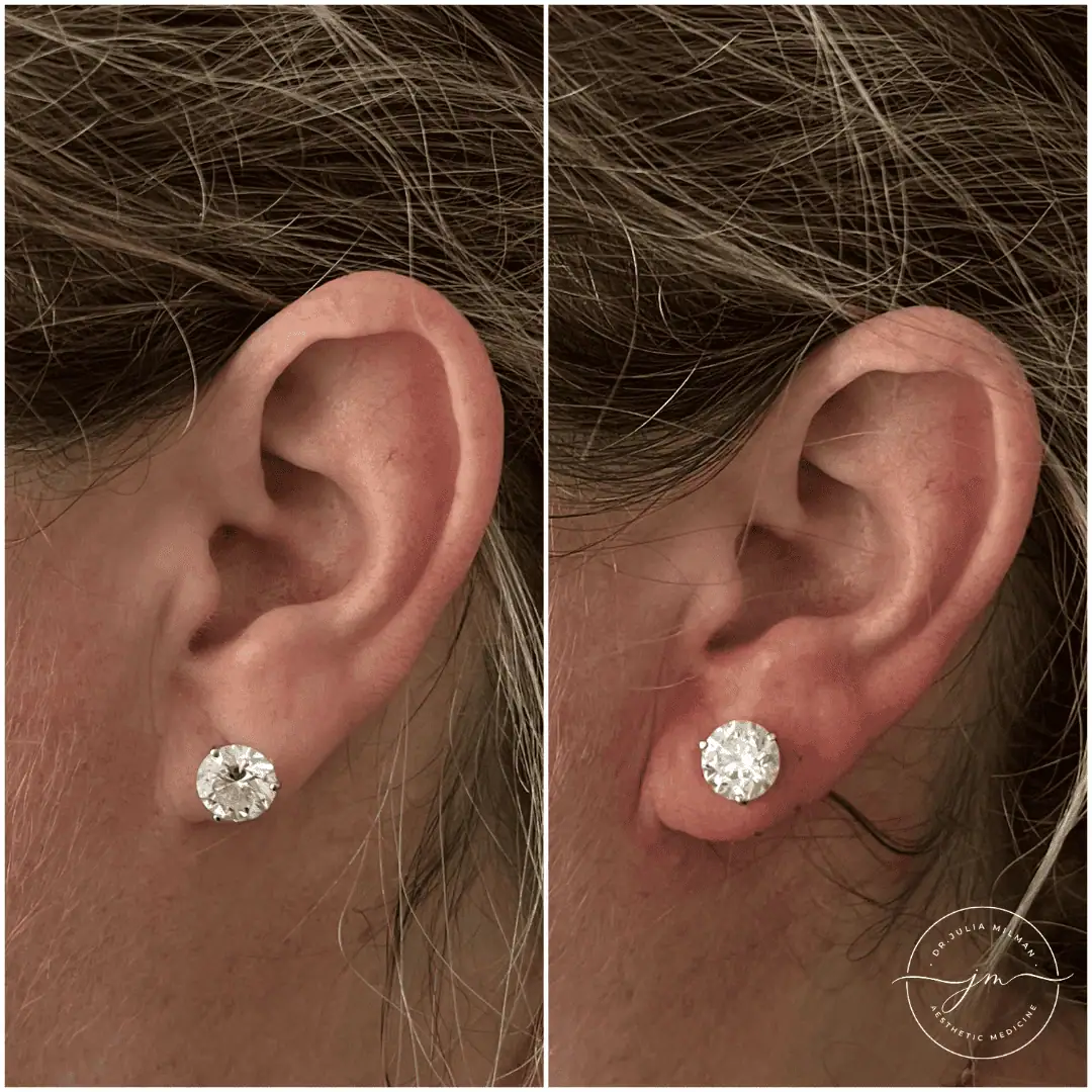 earlobe rejuvenation (2)