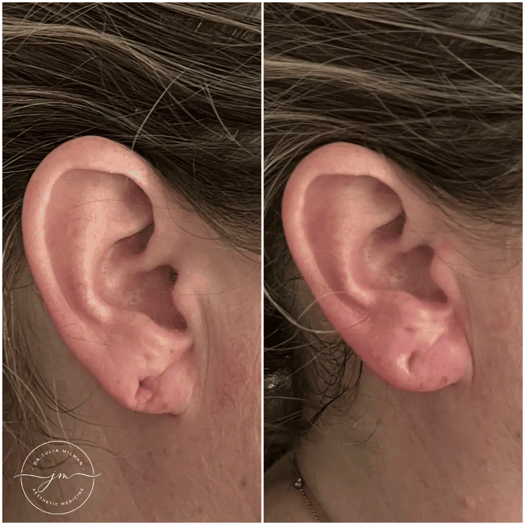 earlobe rejuvenation (3)