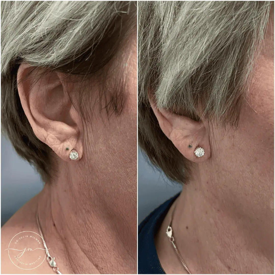 earlobe rejuvenation (5)