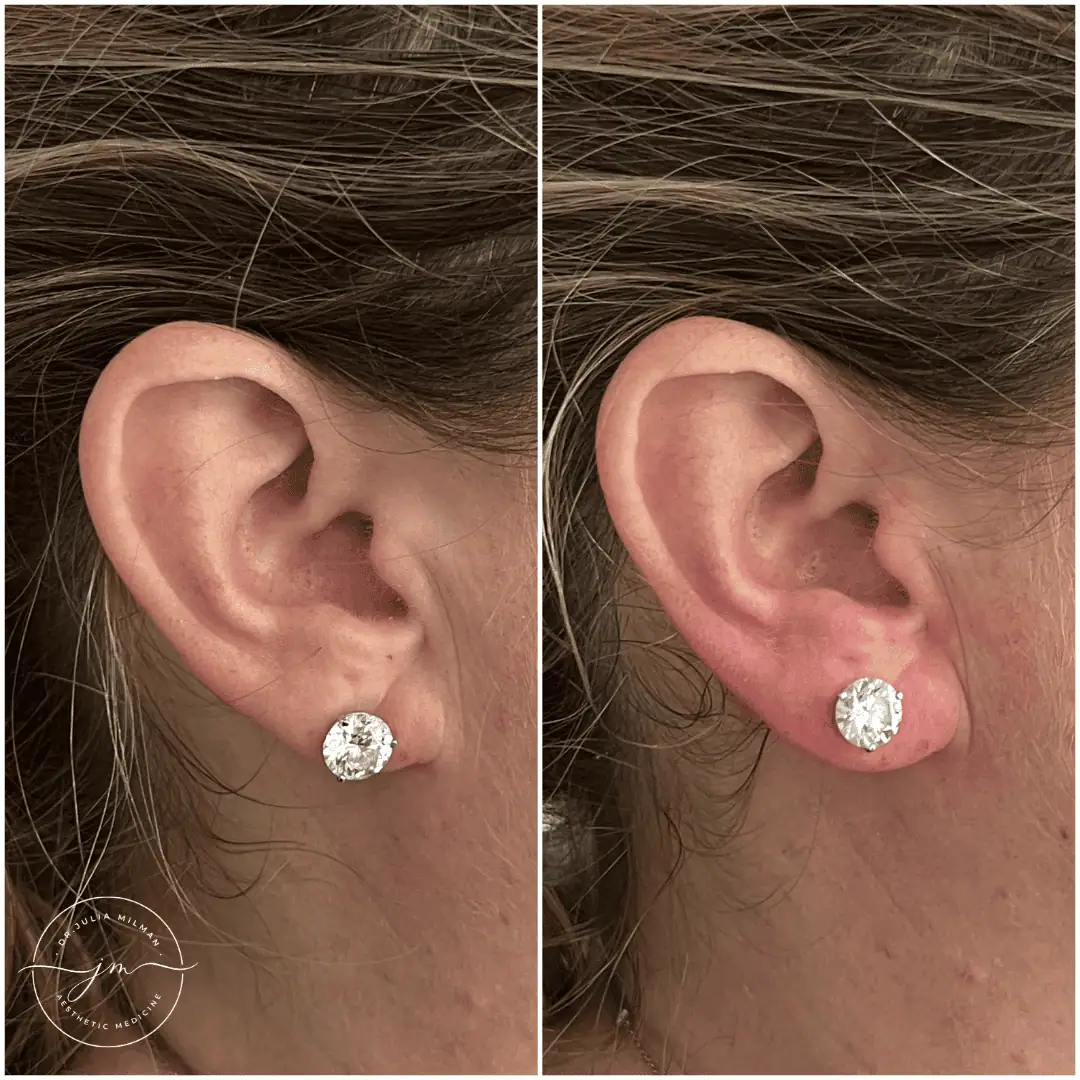 earlobe rejuvenation (6)