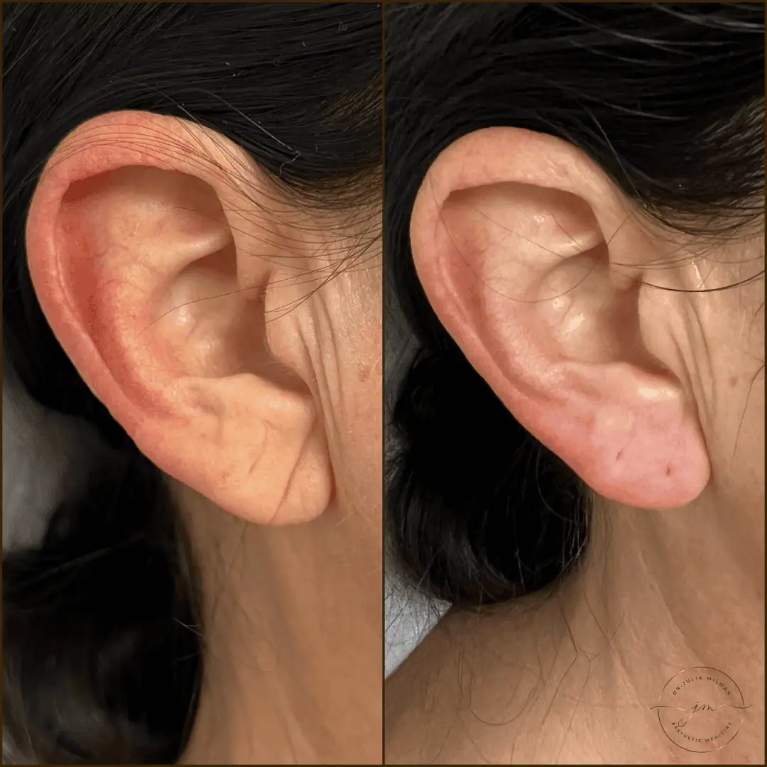 earlobe rejuvenation (7)