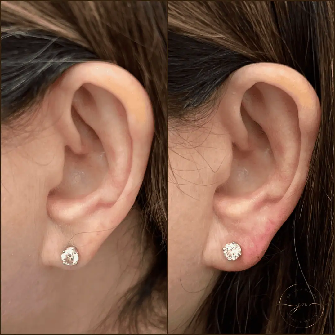 earlobe rejuvenation (8)