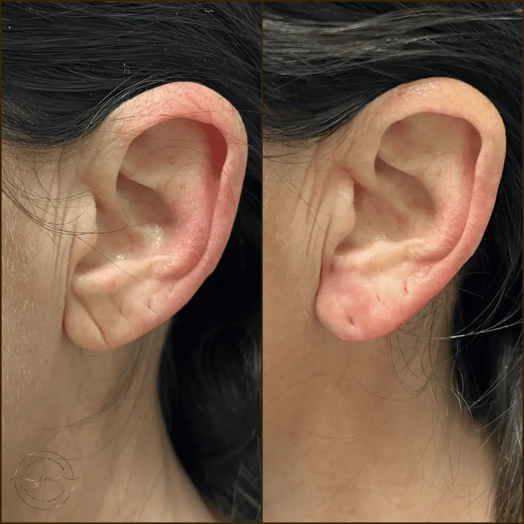 earlobe rejuvenation (9)