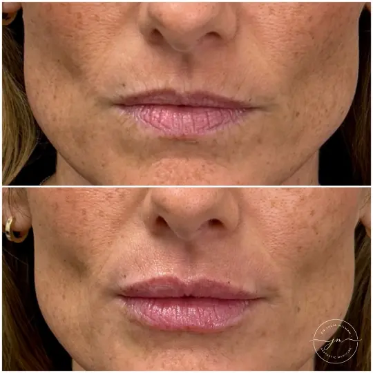 dermal fillers lip restoration (1)