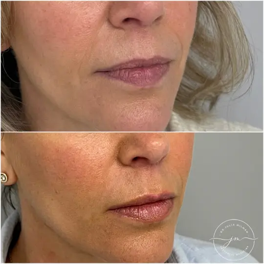 dermal fillers lip restoration (2)