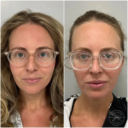 dermal fillers lip restoration (3)