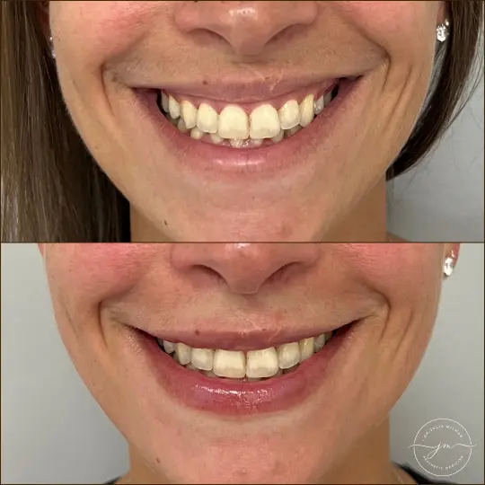dermal fillers lip restoration (4)