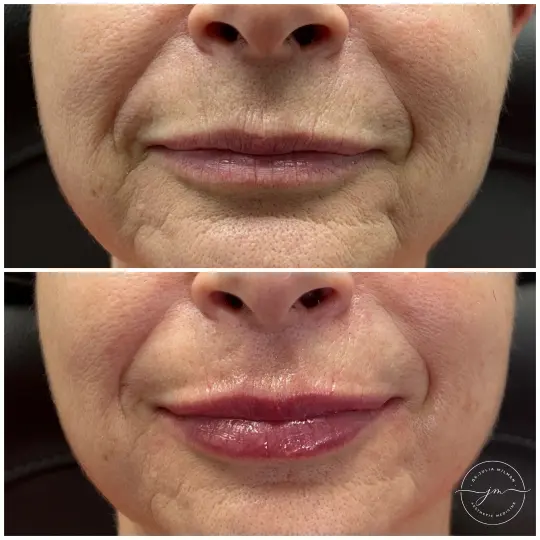 dermal fillers lip restoration (5)