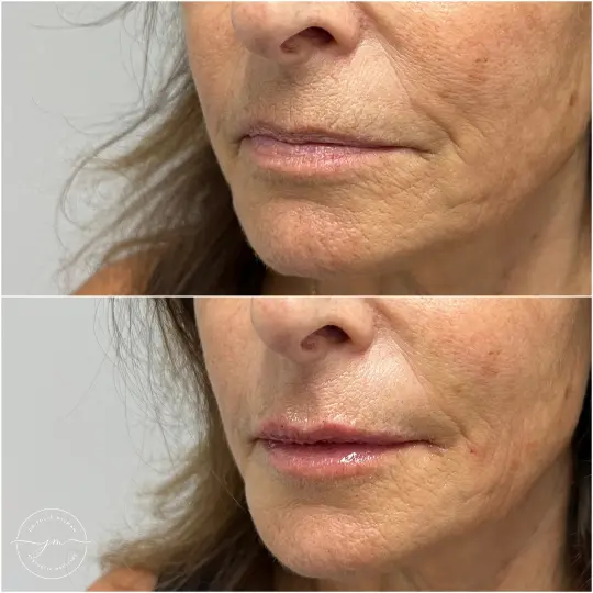 dermal fillers lip restoration (6)