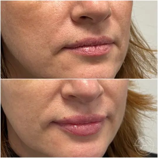 dermal fillers lip restoration (7)