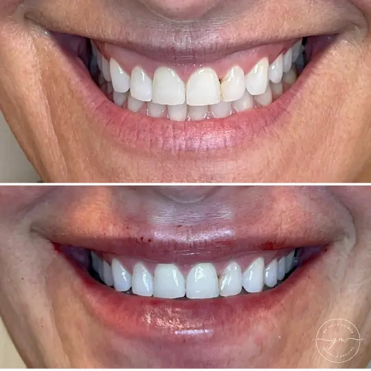 dermal fillers lip restoration (8)