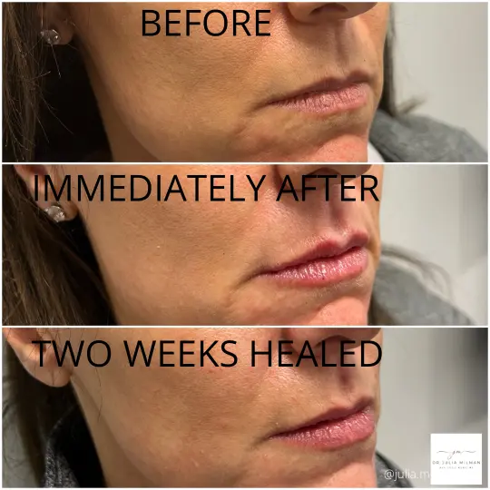 dermal fillers lip restoration (9)